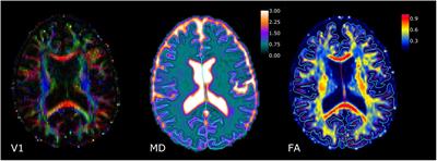 Distribution of Cortical Diffusion Tensor Imaging Changes in Multiple Sclerosis